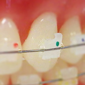 Accent™ Ceramic Brackets, Roth, .022 (1 ct)