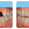 Aligner Pontics 18 692 Before And After 20mar2024