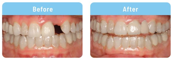 Aligner Pontics 18 692 Before And After 20mar2024